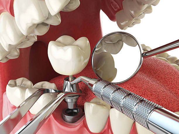 Best Emergency Dentist for Lost Fillings or Crowns in Hardwick, GA